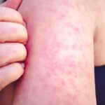 Lubbock Public Health to City: “Don’t Worry, It’s Just a Little Measles”