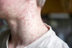 Red measles rash on the neck of a person in Lubbock County during West Texas outbreak.
