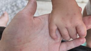 Close-up of an adult and child’s hands showing red spots and rashes consistent with symptoms of Hand, Foot, and Mouth Disease (HFMD), reported at Lubbock daycares.