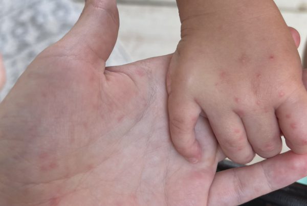 Close-up of an adult and child’s hands showing red spots and rashes consistent with symptoms of Hand, Foot, and Mouth Disease (HFMD), reported at Lubbock daycares.