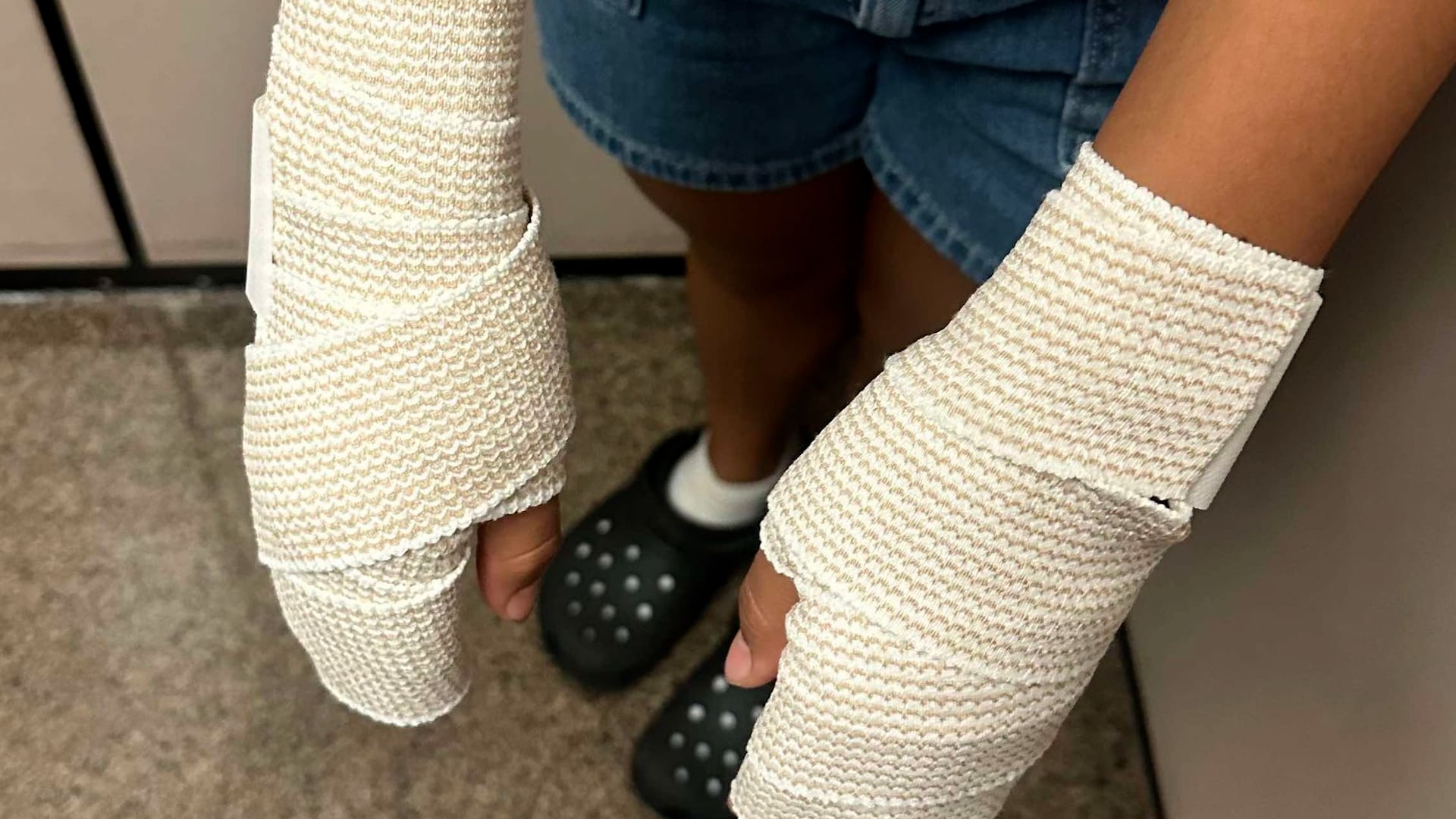 The aftermath of a 125-degree "learning experience": a middle schooler’s hands and wrists heavily wrapped in medical bandages after being forced to bear crawl across the Evans Middle School track while the district looked the other way.